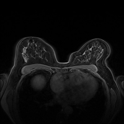 Right upper medial ductal carcinoma in situ T1 FatSat