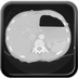 Clinical case 14 - Polytrauma due to high-speed road traffic accident, light vehicle against light vehicle, patient driving and wearing belt