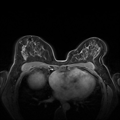 Right upper medial ductal carcinoma in situ Dynamique FS 4 min