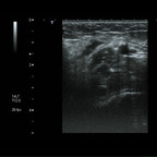 Désinsertion distale du biceps brachial Echographie Membre supérieur Axial Désinsertion distale du biceps brachial Echographie Membre supérieur Axial