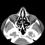 Obstruction fonctionnelle CLN Droit - Sinusite maxillaire Recon 2: SINUS Obstruction fonctionnelle CLN Droit - Sinusite maxillaire Recon 2: SINUS