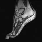 Воспаление подошвенного апоневроза T1 Sagittal Воспаление подошвенного апоневроза T1 Sagittal