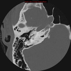 Otospongiose bilatérale péricochléaire TDM rocher droit : axial Otospongiose bilatérale péricochléaire TDM rocher droit : axial