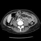 Туберкулез крестца в сопровождении обширного абсцесса Abdomen portal axial Туберкулез крестца в сопровождении обширного абсцесса Abdomen portal axial
