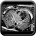 Cardiomyopathie hypertrophique primitive Cine-IRM 4 cavités