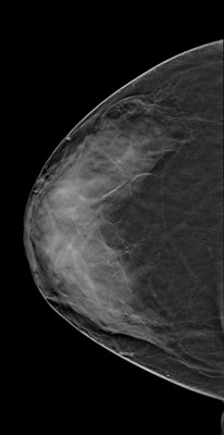 Doubt regarding architectural distortion of the right upper lateral quadrant, corresponding to superimpositions with tomosynthesis. RCC Tomosynthèse