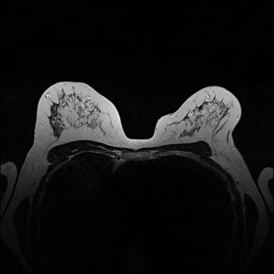 Right upper medial ductal carcinoma in situ T2