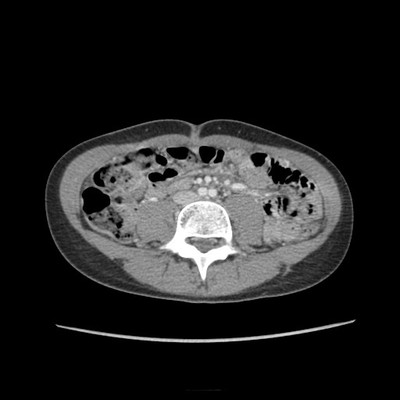 Phéochromocytome et paragangliome dans un contexte de maladie de Von Hippel Lindau TDM Axial