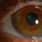 Mélanome iris et corps ciliaire LAF ODG Mélanome iris et corps ciliaire LAF ODG