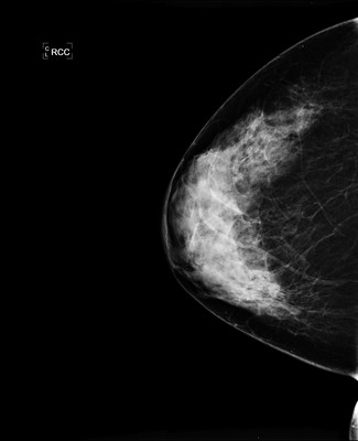 Doubt regarding architectural distortion of the right upper lateral quadrant, corresponding to superimpositions with tomosynthesis. RCC