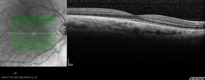 Cataracte sous capsulaire postérieure et astigmatisme cornéen - Implantation multifocale torique OCT maculaire OD
