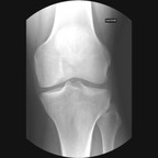 Рассекающий остеохондроз внутреннего бедренного мыщелка 3-ей стадии Radiographie Genou Face Рассекающий остеохондроз внутреннего бедренного мыщелка 3-ей стадии Radiographie Genou Face