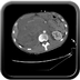 Clinical case 7 - Polytrauma due to road traffic accident, rear passenger, in hemorrhagic shock