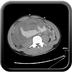 Clinical case 7 - Polytrauma due to road traffic accident, rear passenger, in hemorrhagic shock