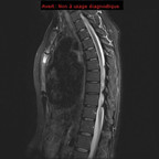Стернит IRM Thorax Sagittal Стернит IRM Thorax Sagittal