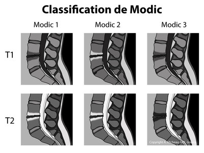 Modic: modifications des plateaux vertébraux en IRM sur discopathie ...