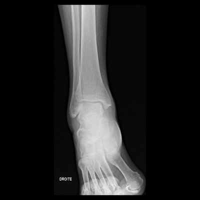 Synovite villonodulaire pigmentée / Ostéoarticulaire / Chaines